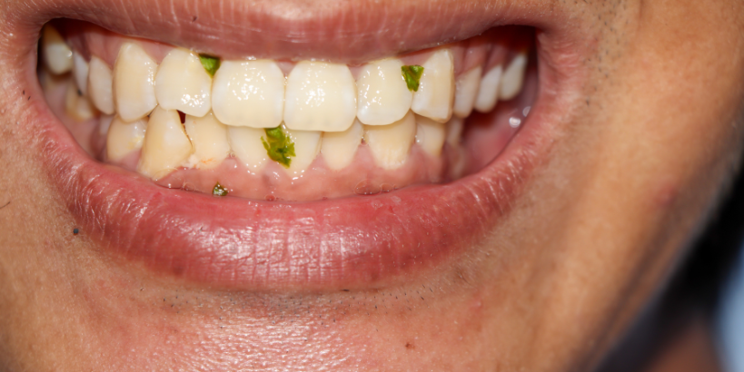 Why Do Teeth Stain and How Can Cosmetic Dentistry Help?